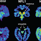 Illustration for article titled New Study Reveals That CTE May Be Detectable In Living Patients
